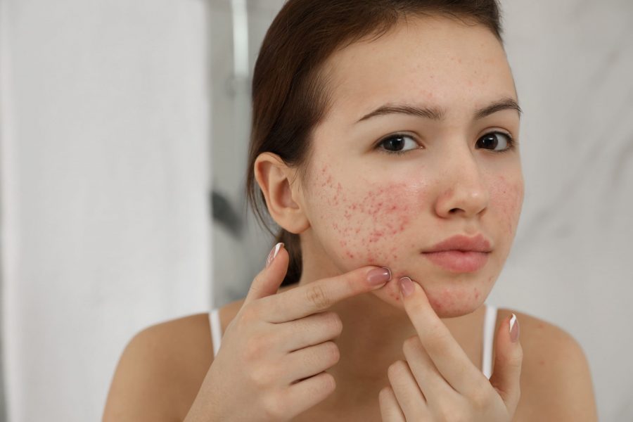 Pele Acneica como prevenir a acne e cuidar desse tipo de pele