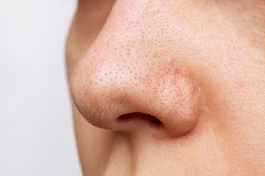 zoom em um nariz com acne de grau 1